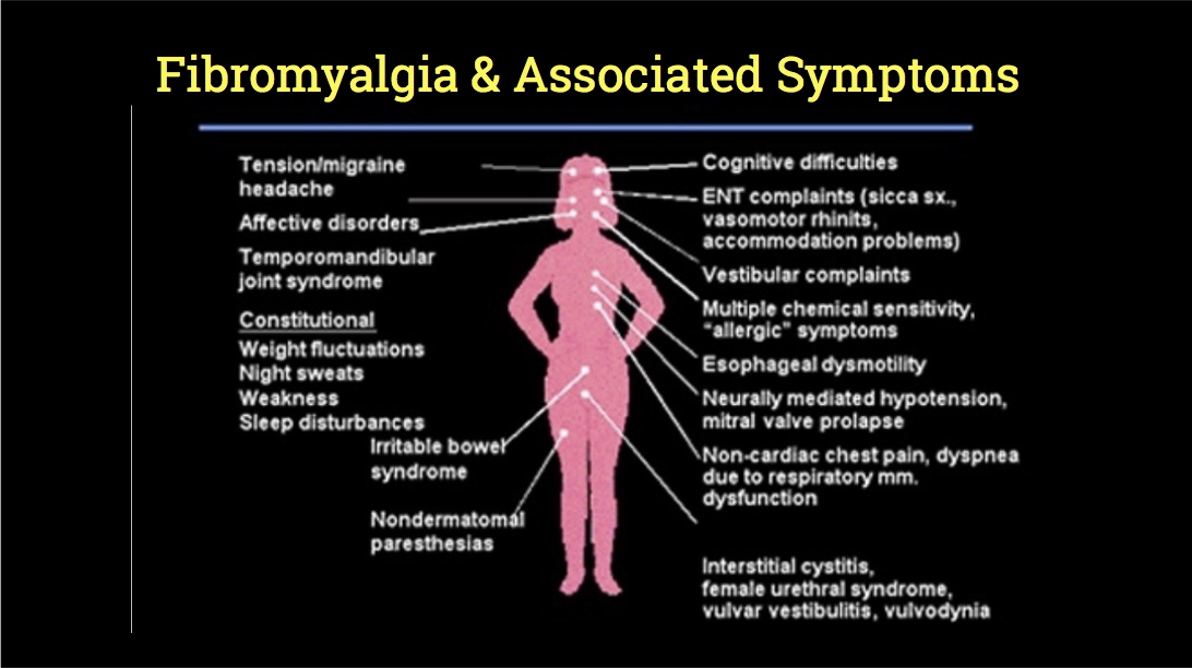 Fibromyalgia 1
