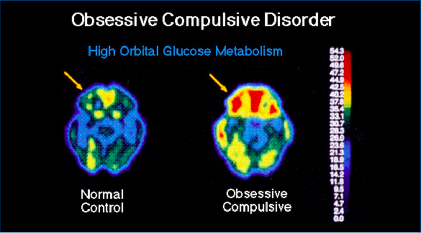Obsessive Compulsive Disorder